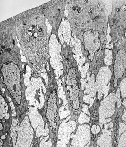  jejunum … lipid malabsorption